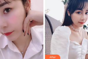 廣州柏德口腔門診部蘭海龍整形價格表附合金烤瓷牙案例展示