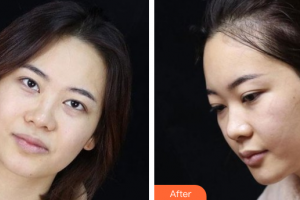 廣州懿美秀醫(yī)療美容門診部羅輝整形價格表附眼部整形案例展示