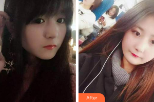 廣州德倫口腔門診部程武整形價格表附牙齒根管調(diào)節(jié)案例展示