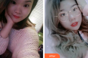 廣州德倫口腔門診部倪靜娥整形價格表附牙齒隱形矯正案例展示