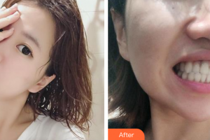 廣州市第十二人民醫(yī)院整形美容科陳家歡整形價格表附隱形托槽矯正案例展示