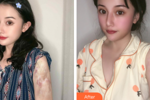 廣州醫(yī)科大學(xué)附屬第一醫(yī)院整形外科曹浩財整形價格表附燙傷疤痕案例展示