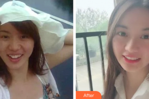 廣州韓佳人醫(yī)療美容醫(yī)院許佳燕整形價格表附金屬托槽矯正牙齒案例展示