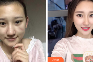 廣州名韓醫(yī)療美容醫(yī)院閆倫整形價格表附手術(shù)疤痕案例展示