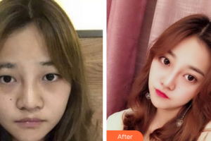 廣州韓佳人醫(yī)療美容醫(yī)院詹曉芳整形價格表附眼部手術(shù)案例展示