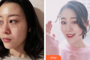 廣州膚康皮膚科醫(yī)院馬在墀整形價格表附凹陷疤痕案例展示