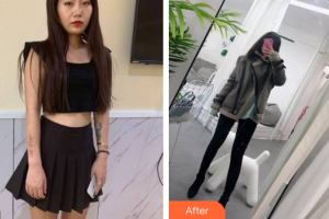 廣州醫(yī)科大學(xué)附屬第一醫(yī)院整形外科梁剛整形價格表附手術(shù)疤痕案例展示