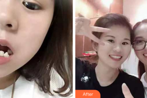 廣州雅度口腔門診部曾融生整形價格表附牙齒矯正案例展示