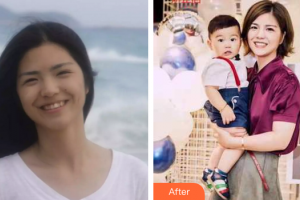 廣州德倫口腔門診部余若鳴整形價格表附牙齒矯正案例展示