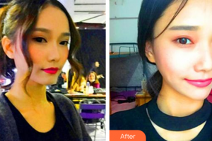 廣州壹加壹美容醫(yī)院姚文波整形價格表附熱瑪吉案例展示