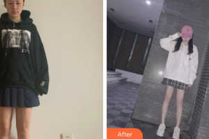 廣州勝康醫(yī)院醫(yī)療美容科趙辨整形價格表附縫針疤痕案例展示