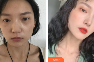 廣州艾美醫(yī)療美容門診部姬付康整形價格表附鼻部整形案例展示