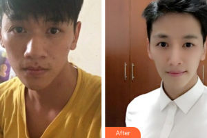 廣州鵬愛醫(yī)療美容門診部黃文亭整形價格表附鼻部手術(shù)案例展示