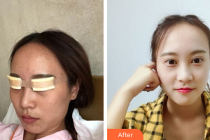 廣州美詩沁醫(yī)療美容門診部趙占國整形價格表附眼部手術(shù)案例展示