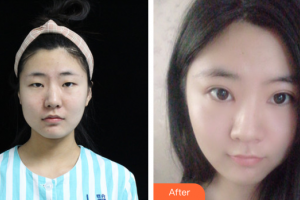 廣州雅度醫(yī)療美容醫(yī)院鄒順祿整形價格表附全切雙眼皮案例展示