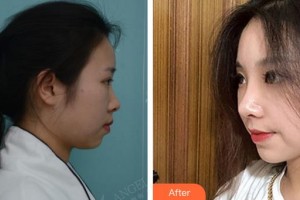 合肥凱美醫(yī)療美容醫(yī)院王文俊整形價(jià)格表附鼻部整形案例展示