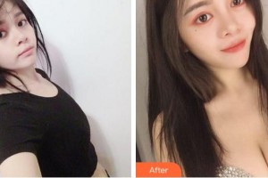 合肥麗人女子醫(yī)院中韓整形美容中心田耿莉整形價格表附假體隆胸案例展示