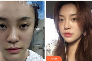 合肥凱美醫(yī)療美容醫(yī)院秦宏智整形價格表附埋線提升案例展示