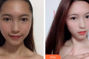 合肥華美整形美容醫(yī)院郭峰整形價格表附眼部綜合案例展示