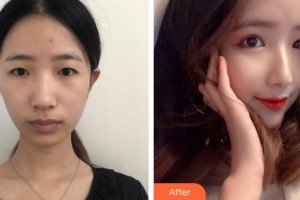 合肥艾雅整形美容醫(yī)院富秋濤整形價格表附眼部案例展示