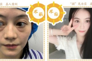 合肥華美整形美容醫(yī)院秦興利整形價格表附埋線提升案例展示