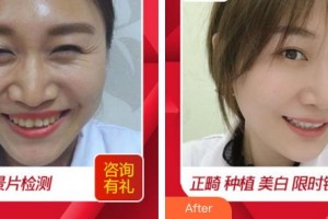 合肥麗人女子醫(yī)院中韓整形美容中心季媛梅 教授整形價格表附美白牙齒案例展示