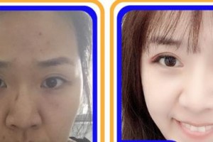 合肥大韓整形美容醫(yī)院郭健整形價格表附眼部綜合案例展示