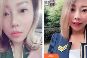 合肥愛春整形美容醫(yī)院范愛春整形價格表附牙齒隱形矯正案例展示