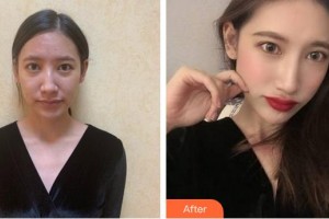 合肥大韓整形美容醫(yī)院申洪國整形價格表附肋軟骨隆鼻案例展示