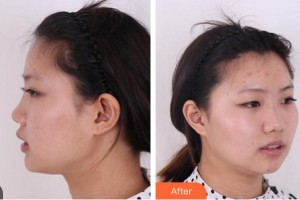 合肥申誠整形美容醫(yī)院程淦整形價格表附鼻部綜合案例展示