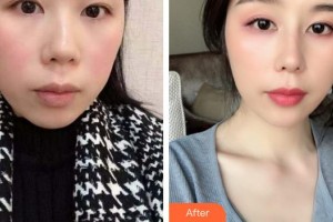 合肥博士整形外科醫(yī)院徐榮成整形價格表附耳軟骨復(fù)合隆鼻案例展示