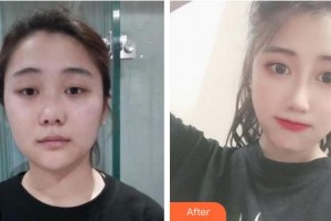 合肥第一人民醫(yī)院整形美容分院孫祥整形價格表附肋軟骨隆鼻案例展示