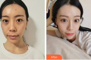 合肥第一人民醫(yī)院整形美容分院左宗寶整形價格表附埋線提升案例展示