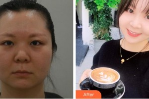 合肥光美醫(yī)療整形美容醫(yī)院朱祖俊整形價格表附多方面部埋線提升案例展示