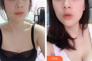 合肥第一人民醫(yī)院整形美容分院青紀(jì)鴻整形價格表附自體脂肪隆胸案例展示