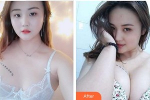 合肥伊爾醫(yī)療美容診所鄭孝威整形價格表附自體脂肪隆胸案例展示