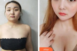 合肥福華醫(yī)療美容醫(yī)院龔細平整形價格表附自體脂肪隆胸案例展示