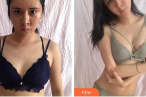 合肥龐博整形美容醫(yī)院龐良霞整形價格表附自體脂肪隆胸案例展示