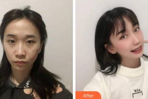 合肥龐博整形美容醫(yī)院李學恕整形價格表附疤痕案例展示