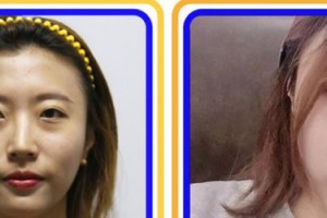 合肥劉大夫美容整形醫(yī)院徐鵬整形價格表附眼部綜合案例展示