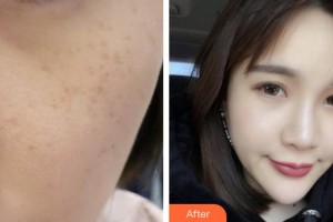 合肥現代婦科醫(yī)院整形美容中心陸玉定整形價格表附激光美膚祛斑案例展示