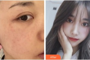 合肥大韓整形美容醫(yī)院張厚感整形價格表附激光美膚激光案例展示