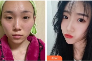 合肥大韓整形美容醫(yī)院衛(wèi)愛俠整形價格表附顴骨內推案例展示