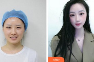 郴州韓雅醫(yī)療美容醫(yī)院王珂整形價格表附雙眼皮案例展示