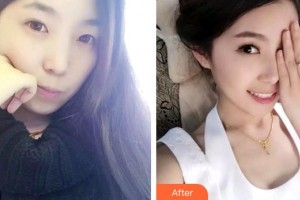 合肥大韓整形美容醫(yī)院劉喻平整形價格表附牙齒隱形矯正案例展示