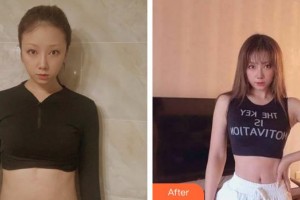 合肥大韓整形美容醫(yī)院張靜整形價格表附疤痕案例展示