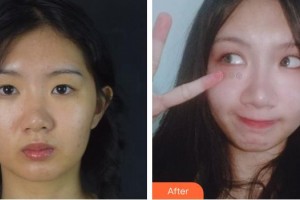 合肥愛春整形美容醫(yī)院傅賢德整形價格表附切開雙眼皮案例展示