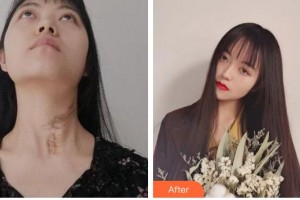 合肥大韓整形美容醫(yī)院梁雅娜整形價格表附激光祛疤案例展示