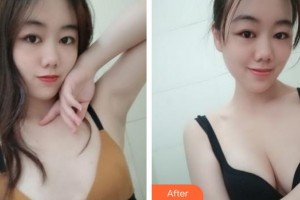 合肥丹鳳朝陽婦科醫(yī)院整形美容外科周蔚整形價格表附自體脂肪隆胸案例展示