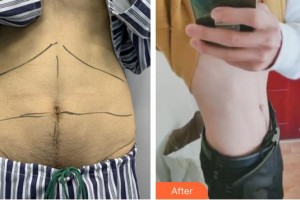 合肥丹鳳朝陽(yáng)婦科醫(yī)院整形美容外科李長(zhǎng)富整形價(jià)格表附腰腹吸脂案例展示